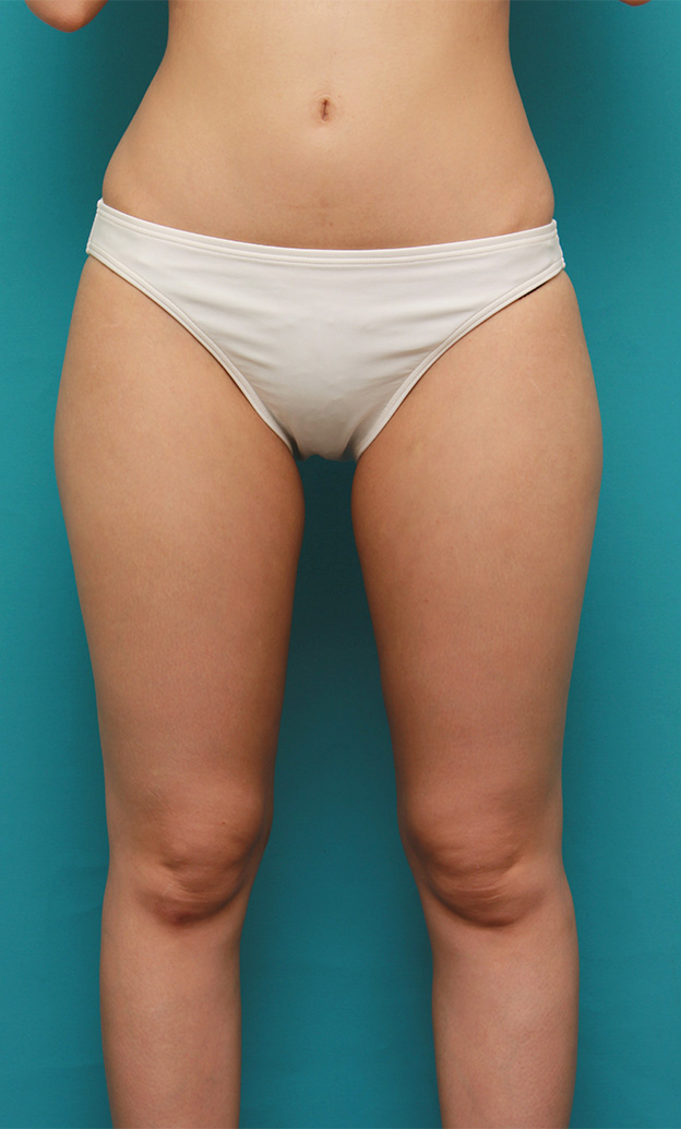 症例写真,イタリアン・メソシェイプ（イタリアンメソセラピー）・脂肪溶解注射で太もも~お尻にかけて全体的に細くした20代女性の症例写真,4回目注射後1ヶ月,mainpic_meso035c.jpg