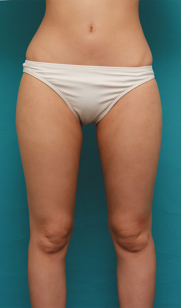 症例写真,イタリアン・メソシェイプ（イタリアンメソセラピー）・脂肪溶解注射で太もも~お尻にかけて全体的に細くした20代女性の症例写真,6回目注射後2ヶ月,mainpic_meso035d.jpg