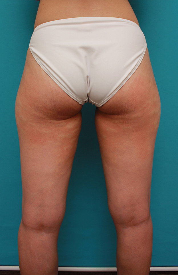 症例写真,イタリアン・メソシェイプ（イタリアンメソセラピー）・脂肪溶解注射で太もも~お尻にかけて全体的に細くした20代女性の症例写真,1回目注射直後,mainpic_meso035f.jpg