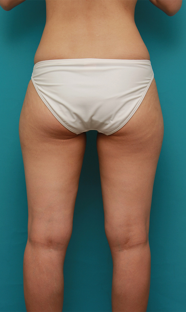 症例写真,イタリアン・メソシェイプ（イタリアンメソセラピー）・脂肪溶解注射で太もも~お尻にかけて全体的に細くした20代女性の症例写真,4回目注射後1ヶ月,mainpic_meso035g.jpg