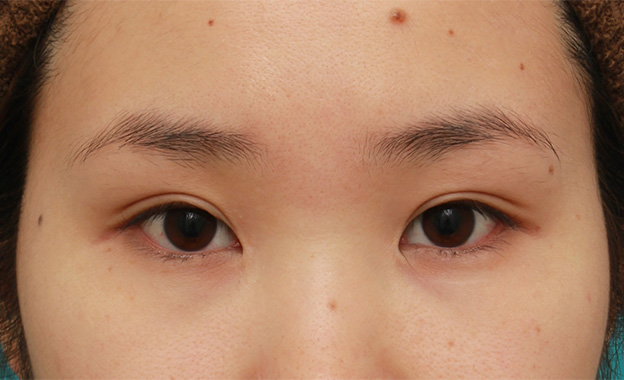 症例写真,目頭切開+二重まぶた全切開法で平行型と末広型の中間くらいのラインになった症例写真,3週間後,mainpic_sekkai046d.jpg