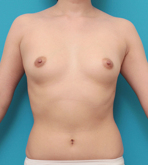 症例写真,豊胸手術で乳腺下に245ccのシリコンプロテーゼを入れた症例写真,Before,ba_hokyo025_b01.jpg