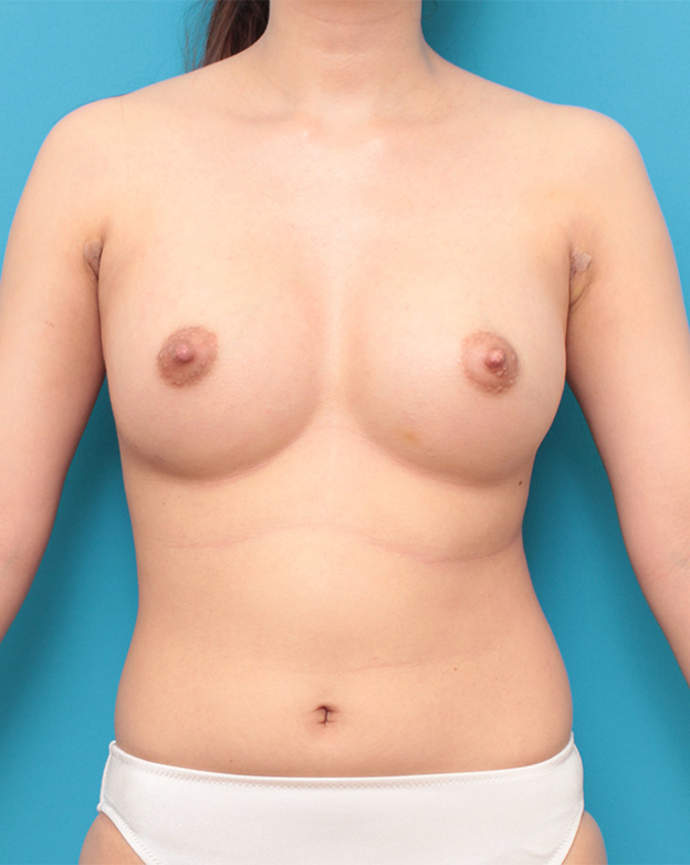 症例写真,豊胸手術で乳腺下に245ccのシリコンプロテーゼを入れた症例写真,1週間後,mainpic_hokyo025c.jpg