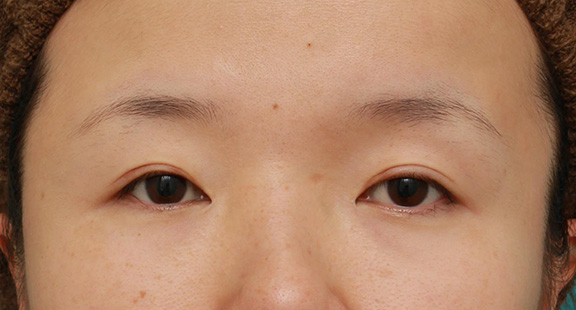 症例写真,眼球自体が小さく開きも悪い目に対して、目頭切開+眼瞼下垂手術で目を一回り大きくした症例写真,After（6ヶ月後）,ba_megashira047_b01.jpg