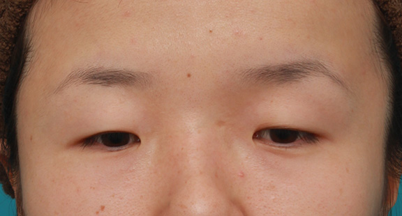 眼球自体が小さく開きも悪い目に対して、目頭切開+眼瞼下垂手術で目を一回り大きくした症例写真,Before,ba_megashira047_b01.jpg