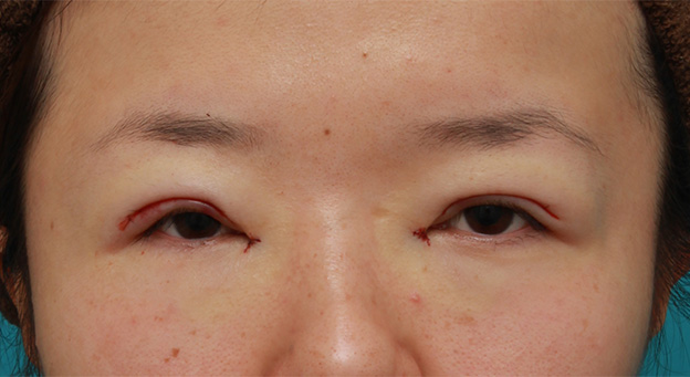 症例写真,眼球自体が小さく開きも悪い目に対して、目頭切開+眼瞼下垂手術で目を一回り大きくした症例写真,手術直後,mainpic_megashira047b.jpg