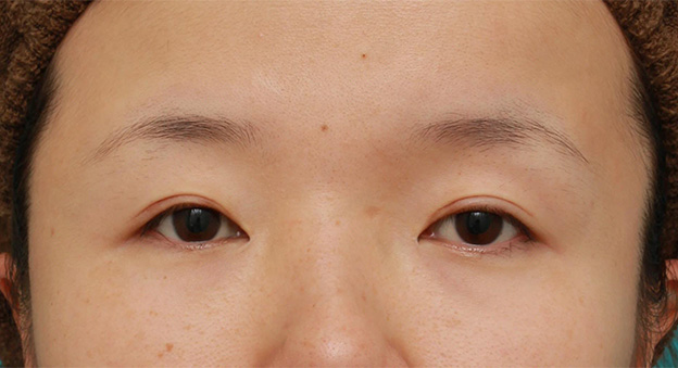 症例写真,眼球自体が小さく開きも悪い目に対して、目頭切開+眼瞼下垂手術で目を一回り大きくした症例写真,6ヶ月後,mainpic_megashira047e.jpg