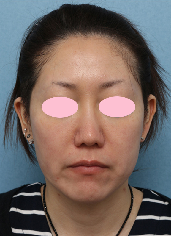 Vシェイプリフト（ヒアルロン酸注射）の症例 両頬をリフトアップしたい女性,Before,ba_v_shapelift004_b01.jpg