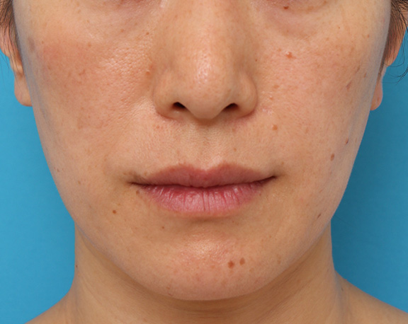 ボツリヌストキシン注射で口角を上げた40代後半女性の症例写真,After（1週間後）,ba_lipsup_botox004_a01.jpg