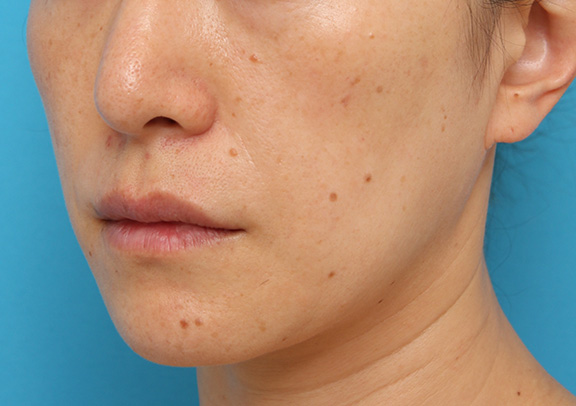 症例写真,ボツリヌストキシン注射で口角を上げた40代後半女性の症例写真,Before,ba_lipsup_botox004_b02.jpg