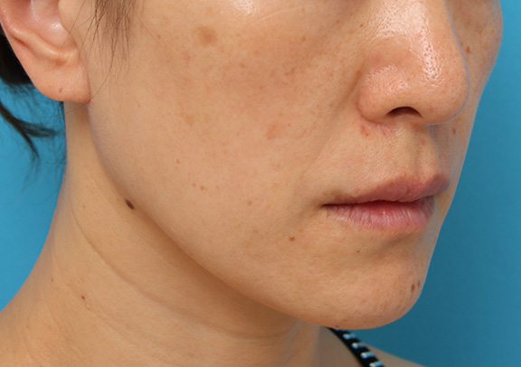 症例写真,ボツリヌストキシン注射で口角を上げた40代後半女性の症例写真,Before,ba_lipsup_botox004_b03.jpg