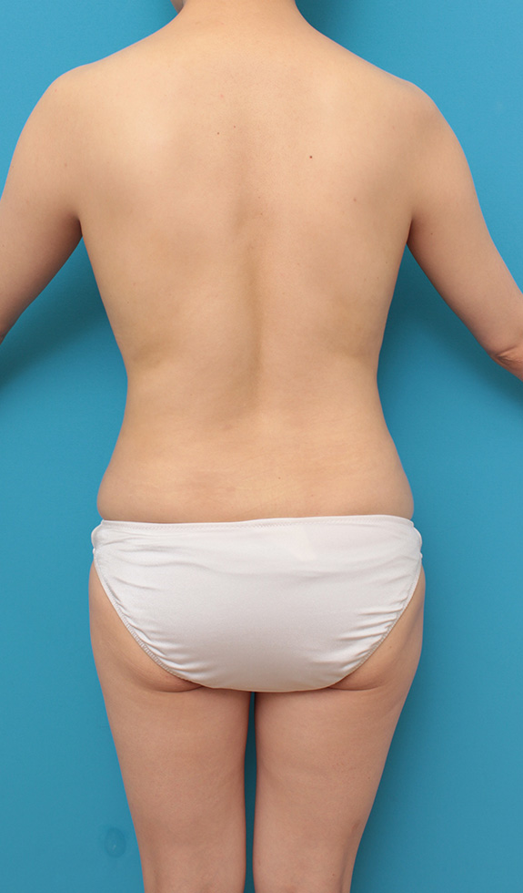 ピュアコンデンス脂肪注入豊胸,お腹回り全体から脂肪吸引し、バストに脂肪注入豊胸した症例写真,After（6ヶ月後）,ba_shibokyuin025_b06.jpg