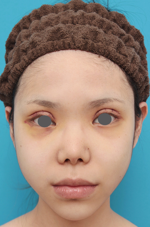 症例写真,上下の厚い唇を手術で程よく薄くした症例写真,Before,ba_usuku007_b01.jpg