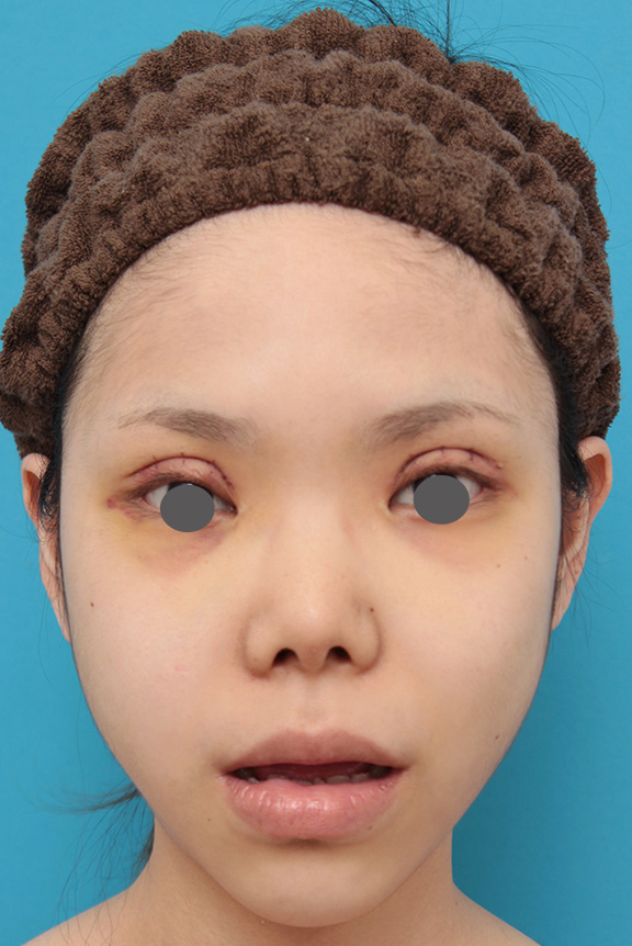 症例写真,上下の厚い唇を手術で程よく薄くした症例写真,Before,ba_usuku007_b02.jpg