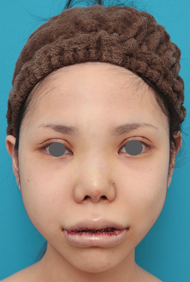 症例写真,上下の厚い唇を手術で程よく薄くした症例写真,手術直後,mainpic_usuku007c.jpg