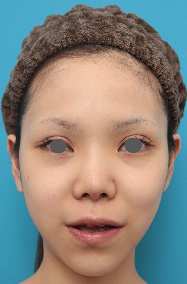 症例写真,上下の厚い唇を手術で程よく薄くした症例写真,1ヶ月後,口を半開きにした状態,mainpic_usuku007g.jpg