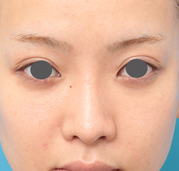 症例写真,鼻プロテーゼと耳介軟骨移植と小鼻縮小を同時に行った症例写真,After（9ヶ月後）,ba_ryubi1035_b01.jpg