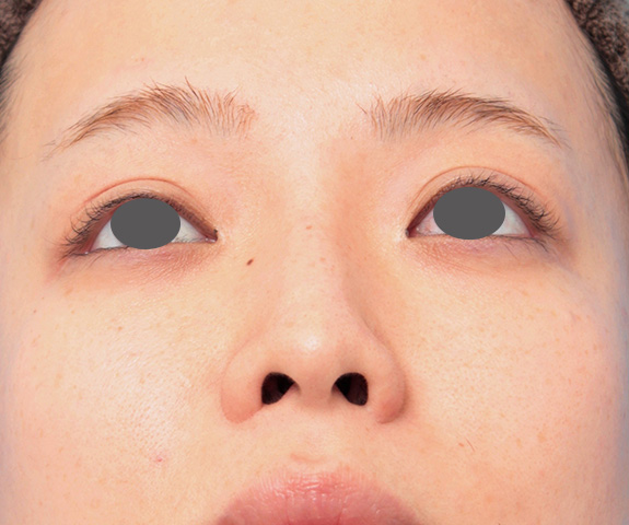 症例写真,鼻プロテーゼと耳介軟骨移植と小鼻縮小を同時に行った症例写真,After（9ヶ月後）,ba_ryubi1035_b02.jpg