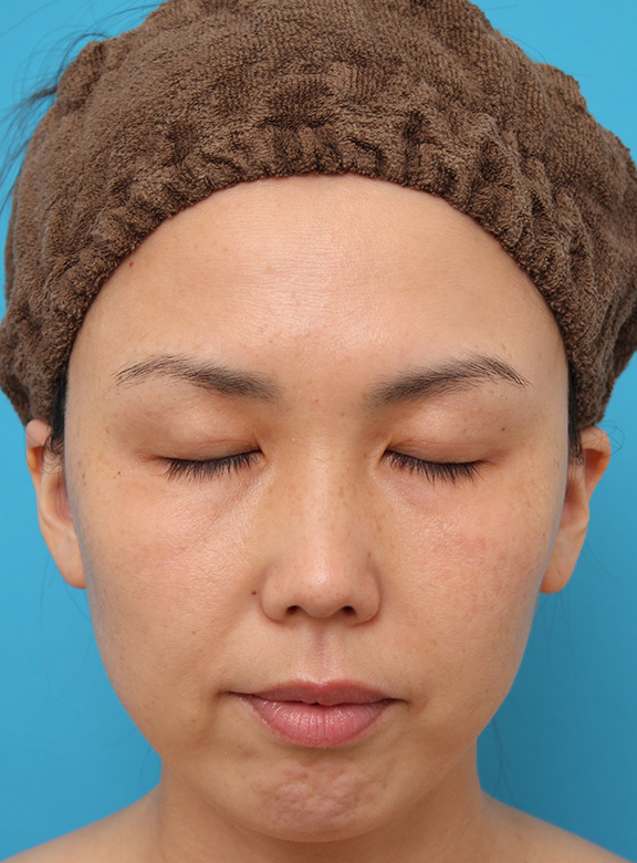 症例写真,二重まぶた埋没法2針固定でたるんでいる皮膚を持ち上げて目を大きくした30代女性の症例写真,After（6ヶ月後）,
