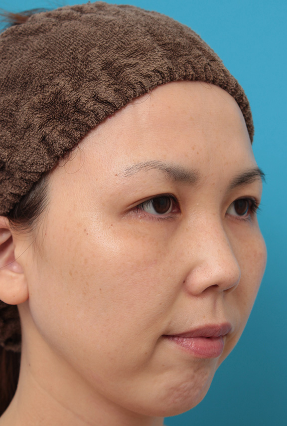 症例写真,二重まぶた埋没法2針固定でたるんでいる皮膚を持ち上げて目を大きくした30代女性の症例写真,After（6ヶ月後）,ba_maibotsu036_b03.jpg