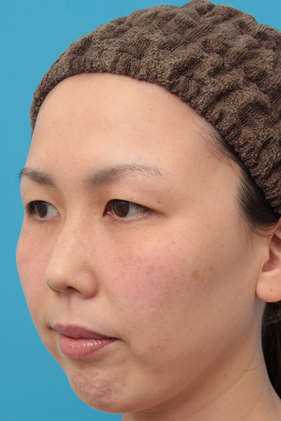 症例写真,二重まぶた埋没法2針固定でたるんでいる皮膚を持ち上げて目を大きくした30代女性の症例写真,Before,ba_maibotsu036_b02.jpg