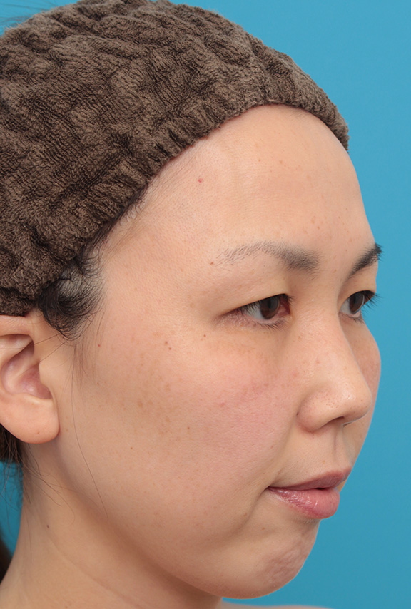 症例写真,二重まぶた埋没法2針固定でたるんでいる皮膚を持ち上げて目を大きくした30代女性の症例写真,Before,ba_maibotsu036_b03.jpg