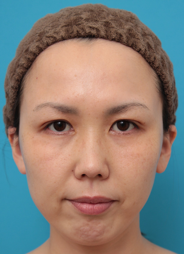 症例写真,二重まぶた埋没法2針固定でたるんでいる皮膚を持ち上げて目を大きくした30代女性の症例写真,5日後,目を開けた状態,mainpic_maibotsu036d.jpg