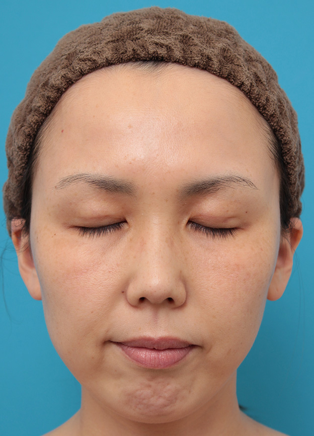 症例写真,二重まぶた埋没法2針固定でたるんでいる皮膚を持ち上げて目を大きくした30代女性の症例写真,5日後,目を閉じた状態,mainpic_maibotsu036e.jpg