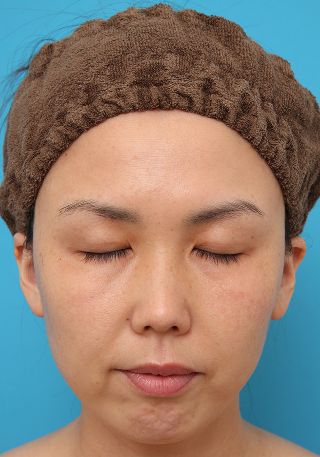 症例写真,二重まぶた埋没法2針固定でたるんでいる皮膚を持ち上げて目を大きくした30代女性の症例写真,3ヶ月後,目を閉じた状態,mainpic_maibotsu036i.jpg