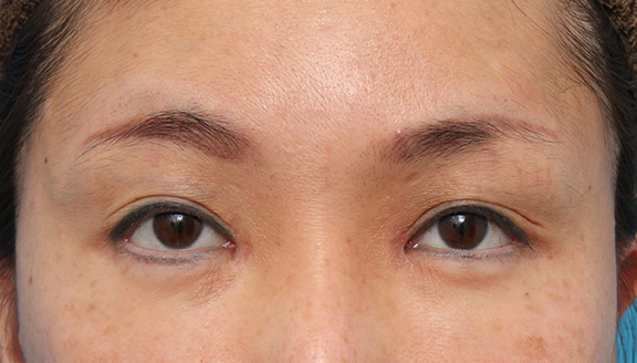 症例写真,他院で切られ過ぎた目頭切開を蒙古襞形成で修正した症例写真,After（6ヶ月後）,ba_hida007_b01.jpg