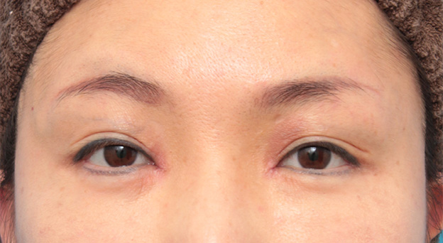 症例写真,他院で切られ過ぎた目頭切開を蒙古襞形成で修正した症例写真,1週間後,mainpic_hida007c.jpg