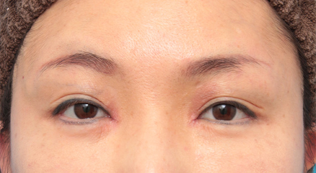 症例写真,蒙古ひだ形成・目頭切開後の修正症例 他院治療の目頭を蒙古襞形成で修正,1週間後,mainpic_hida007c.jpg