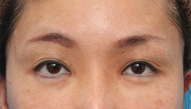 症例写真,他院で切られ過ぎた目頭切開を蒙古襞形成で修正した症例写真,6ヶ月後,mainpic_hida007d.jpg