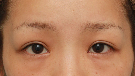 症例写真,他院で二重まぶた切開法を受けた後、眼瞼下垂手術に準じて修正し、同時に目頭切開も行った症例,After（修正手術後6ヶ月）,ba_sekkai047_b01.jpg