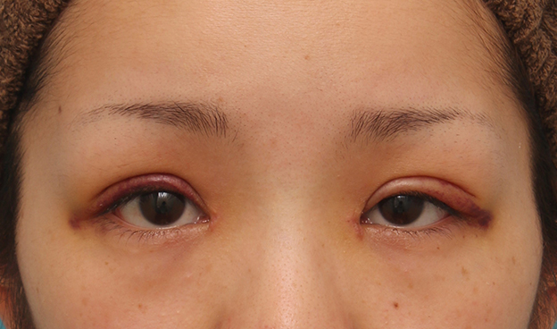 症例写真,他院で二重まぶた切開法を受けた後、眼瞼下垂手術に準じて修正し、同時に目頭切開も行った症例,1週間後,mainpic_sekkai047c.jpg