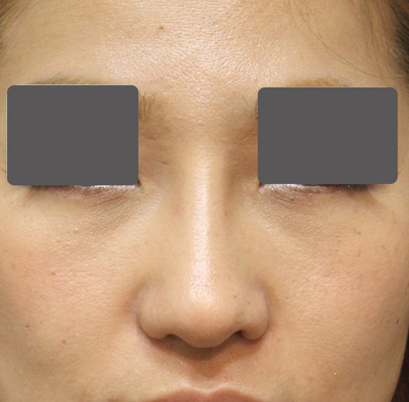 症例写真,5mmの鼻シリコンプロテーゼ+小鼻（鼻翼）縮小手術を行った20代女性の症例写真,After（6ヶ月後）,ba_ryubi1037_b01.jpg