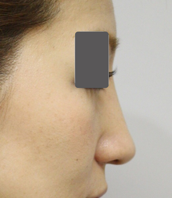 症例写真,5mmの鼻シリコンプロテーゼ+小鼻（鼻翼）縮小手術を行った20代女性の症例写真,After（6ヶ月後）,ba_ryubi1037_b03.jpg