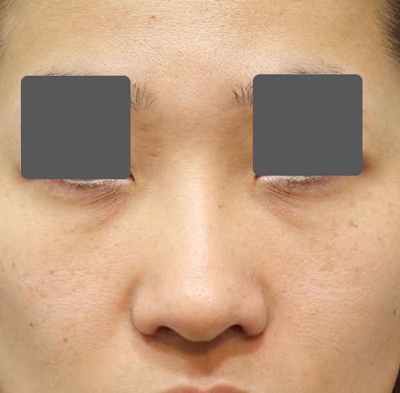 5mmの鼻シリコンプロテーゼ+小鼻（鼻翼）縮小手術を行った20代女性の症例写真,Before,ba_ryubi1037_b01.jpg