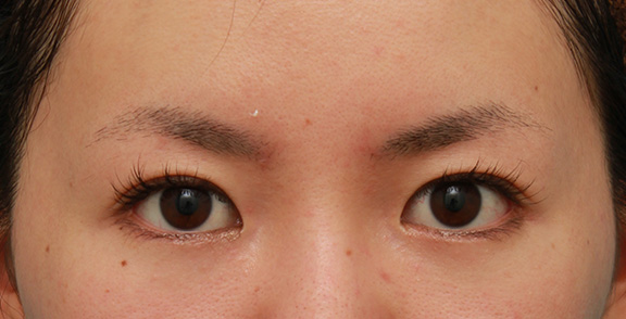 症例写真,目尻切開とタレ目形成（グラマラスライン）を同時に行った20代女性の症例写真,After（6ヶ月後）,ba_mejiri013_b01.jpg