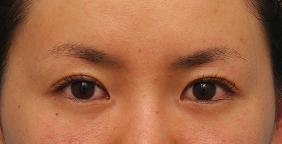 目尻切開とタレ目形成（グラマラスライン）を同時に行った20代女性の症例写真,Before,ba_mejiri013_b01.jpg