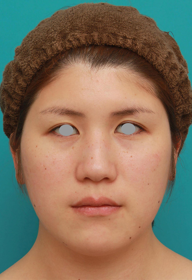 症例写真,頬、フェイスライン、二重顎の脂肪吸引をして小顔になった症例写真,手術前,mainpic_shibo003a.jpg