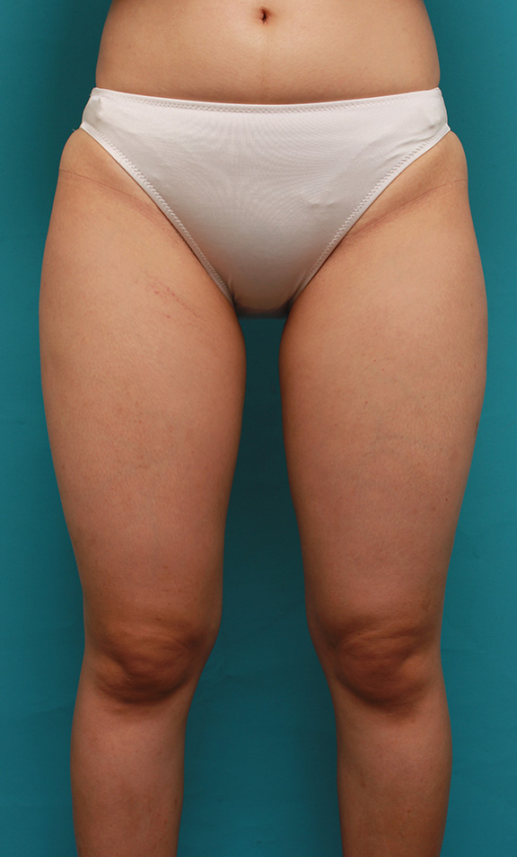 症例写真,太もも全体にイタリアン・メソシェイプ（イタリアンメソセラピー）・脂肪溶解注射をして、一回り細くなった症例写真,Before,ba_meso037_b01.jpg