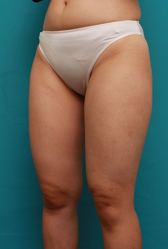 症例写真,太もも全体にイタリアン・メソシェイプ（イタリアンメソセラピー）・脂肪溶解注射をして、一回り細くなった症例写真,Before,ba_meso037_b02.jpg