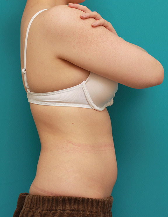 脂肪吸引,二の腕とお腹回りの脂肪吸引を同時に行った症例写真,Before,ba_shibokyuin027_b03.jpg