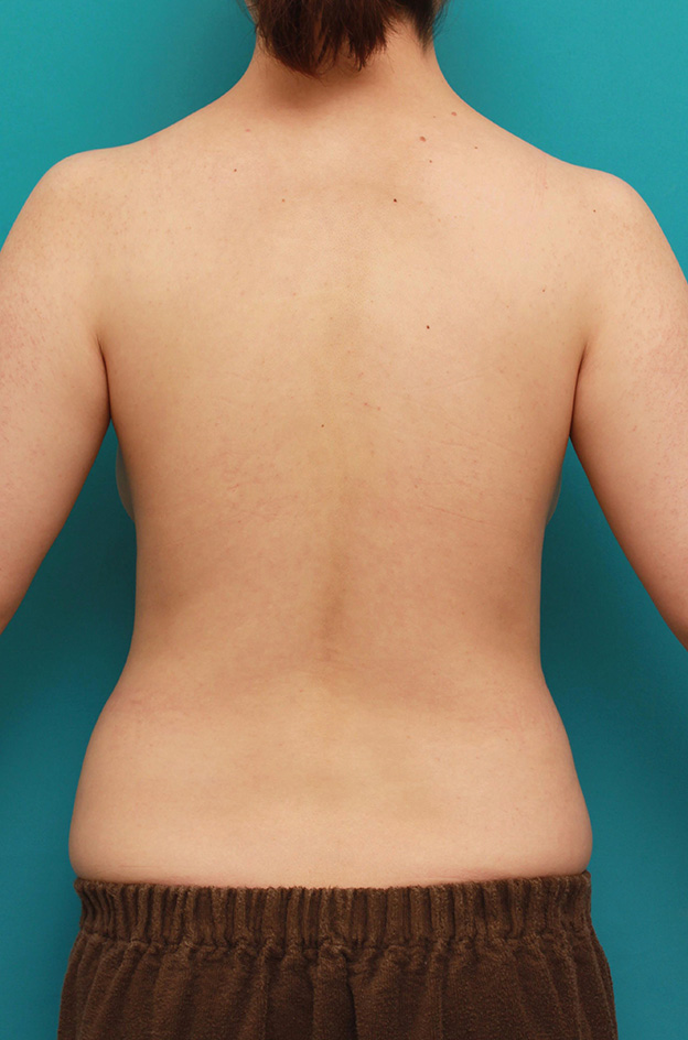 症例写真,二の腕とお腹回りの脂肪吸引を同時に行った症例写真,手術前,mainpic_shibokyuin027p.jpg