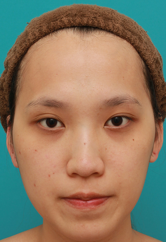 症例写真,鼻に3.5mmの高さのシリコンプロテーゼを入れて、自然に鼻筋を通した症例写真,Before,ba_ryubi1038_b01.jpg