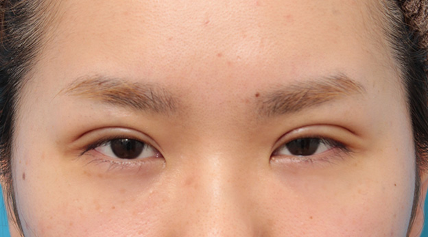 症例写真,ミニ切開法で幅が広すぎない二重まぶたを作った症例写真,1週間後,mainpic_mini_sekkai040c.jpg