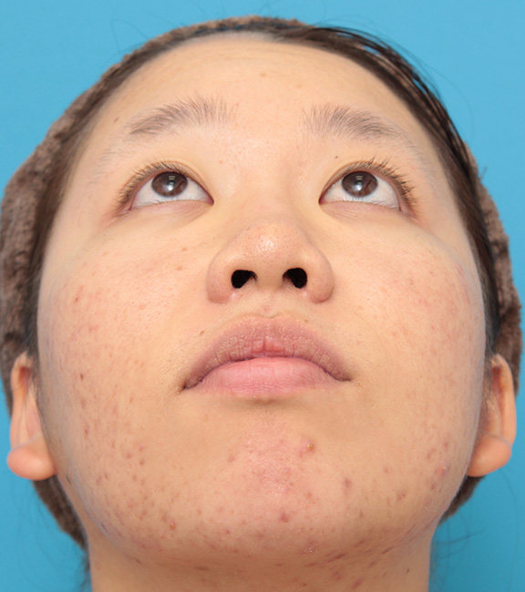 症例写真,小鼻（鼻翼）縮小手術で鼻の穴の内側から外側の途中にかけて切除した症例写真,After（8ヶ月後）,ba_biyoku039_b02.jpg