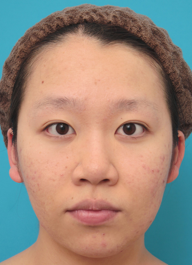 症例写真,小鼻（鼻翼）縮小手術で鼻の穴の内側から外側の途中にかけて切除した症例写真,手術前,mainpic_biyoku039a.jpg