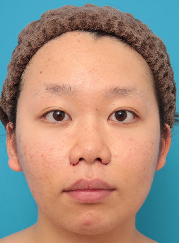 症例写真,小鼻（鼻翼）縮小手術で鼻の穴の内側から外側の途中にかけて切除した症例写真,手術直後,mainpic_biyoku039b.jpg